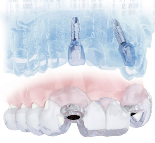 dental implants tulsa