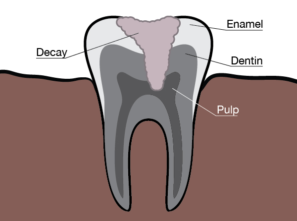 tooth-sensitive-tulsa-dentist
